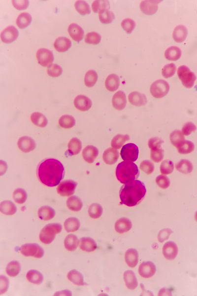 Leucemia mieloide acuta, scoperto da ricercatori italiani il silenziatore molecolare alla base delle recidive